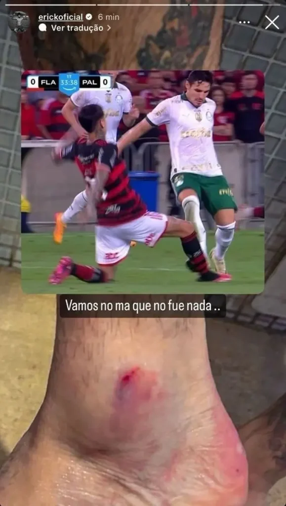 "Jogador do Flamengo compartilha foto de lesão no tornozelo após partida contra o Palmeiras"